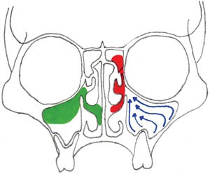 Maxillary sinus disease: diagnosis and treatment