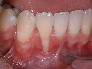 Gingival recession: part 1. Aetiology and non-surgical management | British  Dental Journal