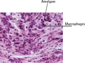 Presentation of amalgam tattoo on buccal mucosa of maxillary  Download  Scientific Diagram