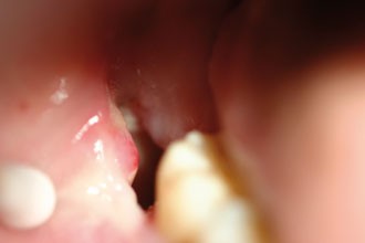 Influence of immediate post-extraction socket irrigation on development of  alveolar osteitis after mandibular third molar removal: a prospective  split-mouth study, preliminary report