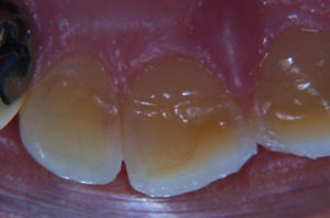 Worn Teeth Repair & Restoration, Ringwood Dental