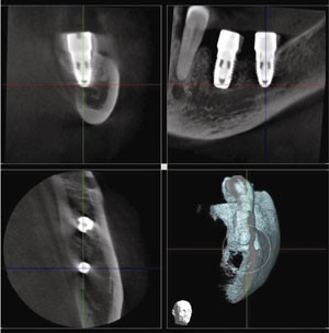 Mandibular nerve dental surgery