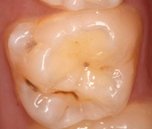 Sticky Molar BADER®️ DENTAL - Bader®️ Dental