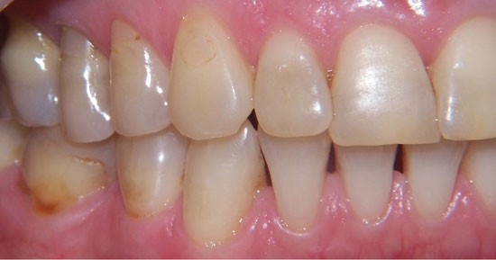 Safety issues of tooth whitening using peroxide-based materials | British  Dental Journal