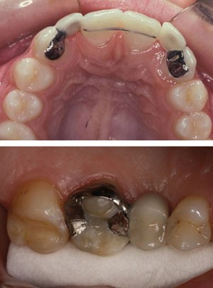 A review of the success and failure characteristics of resin-bonded bridges  | British Dental Journal