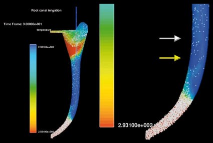 Irrigation in endodontics | British Dental Journal