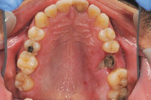 Interventions for the prevention of dry socket: an evidence-based update |  British Dental Journal