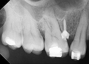 Advances in orthodontic anchorage with the use of mini-implant techniques |  British Dental Journal