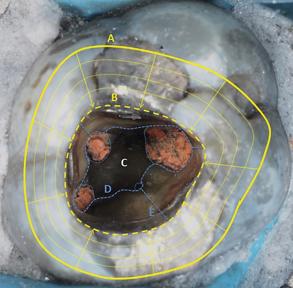 A Practitioner S Guide To Gutta Percha Removal During Endodontic