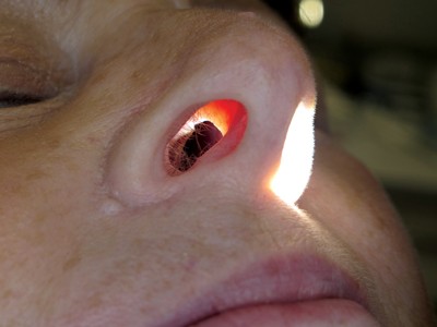 Otolaryngology: Nasal perforation | British Dental Journal