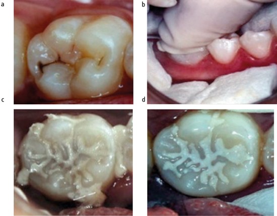 Revitalize Your Smile: Advanced Dental Restoration Techniques