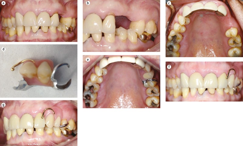 sour Inspect to play Unilateral removable partial dentures | British Dental Journal