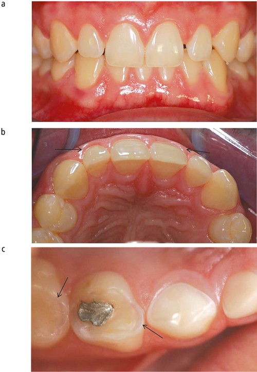 Mean scores for dental caries in the mandibu- lar molars of each group.