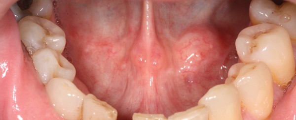 Sub Mucosal Swelling British Dental