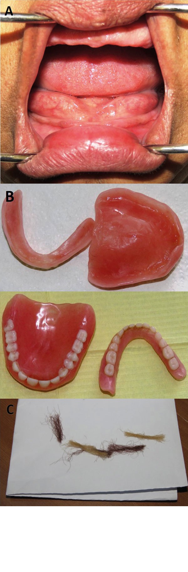 dentist tapeworm