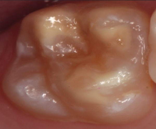 Molar Incisor Hypomineralisation Mih An Overview British