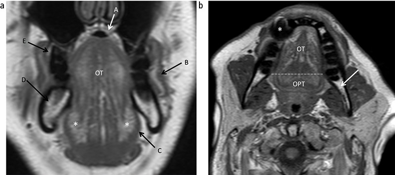 Imaging Patients With Cancer Of The Oral Cavity British Dental