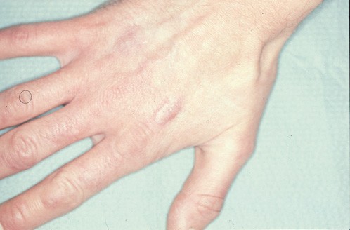 Eating disorders and the dentist | British Dental Journal