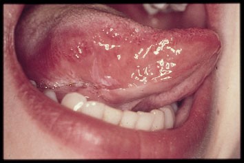 Aggressive cancer of the tongue Throat Cancer and HPV human papilloma lesion