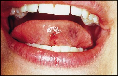 Tongue piercing resulting in hypotensive collapse | British Dental Journal