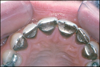 Crowns and other extra-coronal restorations: Resin-bonded metal  restorations | British Dental Journal