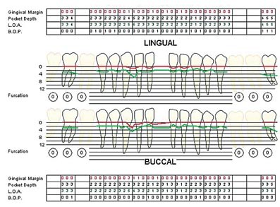 Periodontal Charting Examples