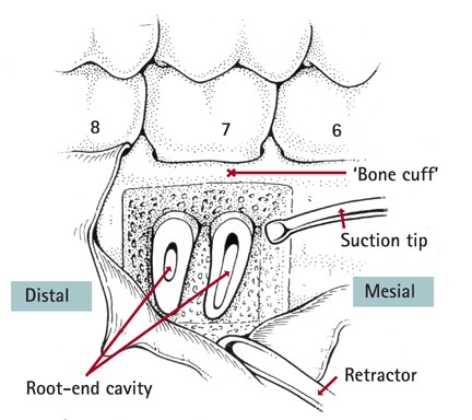 Molar apicectomy with amalgam root-end filling: results of a