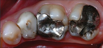 New resin composites used to restore both anterior and posterior teeth |  British Dental Journal