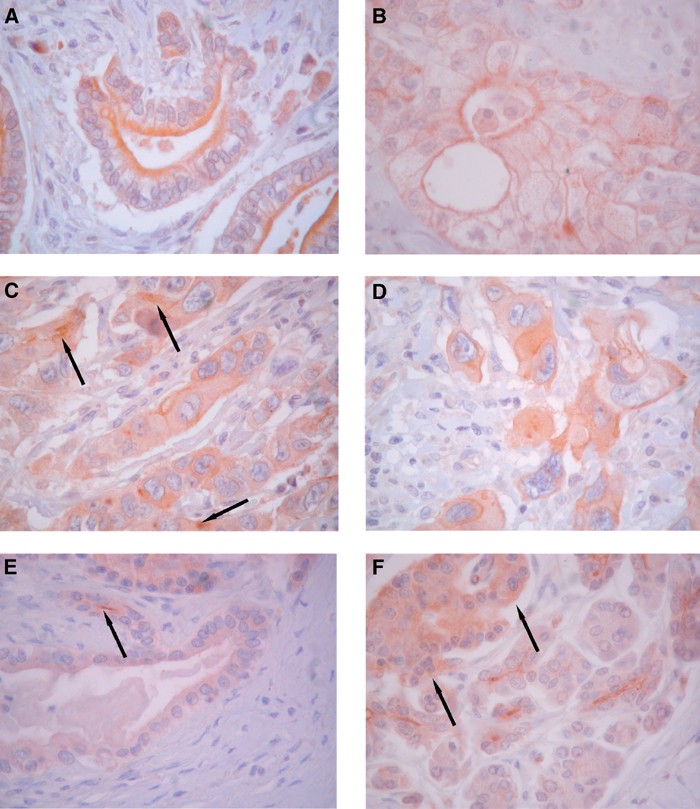 Adam9 Expression In Pancreatic Cancer Is Associated With Tumour Type And Is A Prognostic Factor In Ductal Adenocarcinoma British Journal Of Cancer