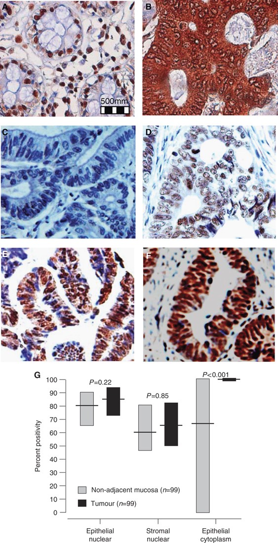 enhed Børnepalads træ Nuclear oxidative damage correlates with poor survival in colorectal cancer  | British Journal of Cancer