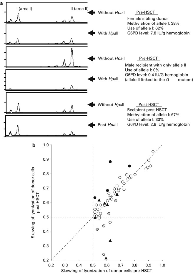 G6pd Deficiency From Lyonization After Hematopoietic Stem Cell Transplantation From Female Heterozygous Donors Bone Marrow Transplantation