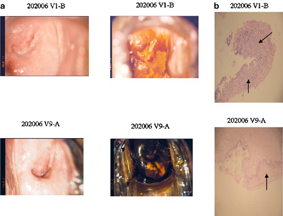 Regression of papilloma high-grade lesions (CIN 2 and CIN 3) is stimulated  by therapeutic vaccination with MVA E2 recombinant vaccine | Cancer Gene  Therapy