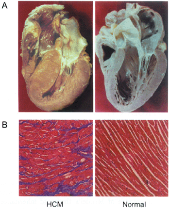 hypertrophy of the heart