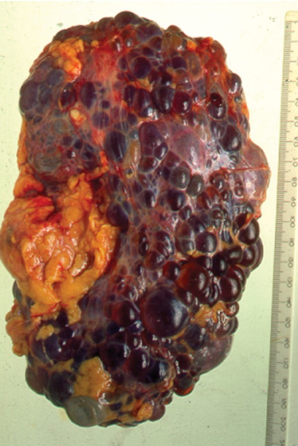 What is the Life Expectancy of Someone With Polycystic Kidney Disease?