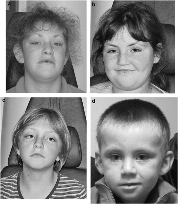Kabuki syndrome: new ocular findings but no evidence of 8p22-p23.1  duplications in a clinically defined cohort | European Journal of Human  Genetics