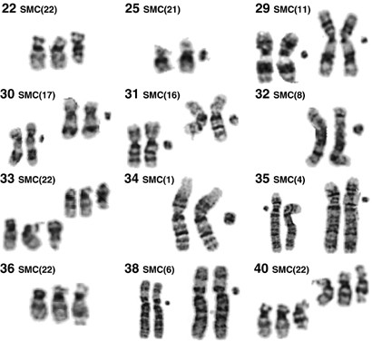 Forty-two supernumerary marker chromosomes (SMCs) in 43 273 prenatal  samples: chromosomal distribution, clinical findings, and UPD studies |  European Journal of Human Genetics