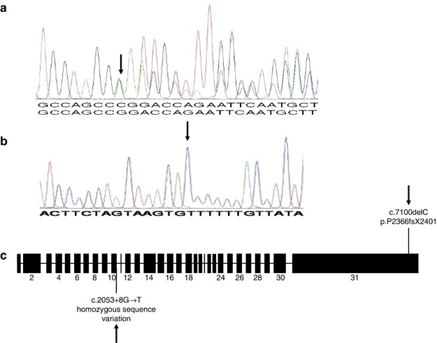 Identification of de novo EP300 and PLAU variants in a patient