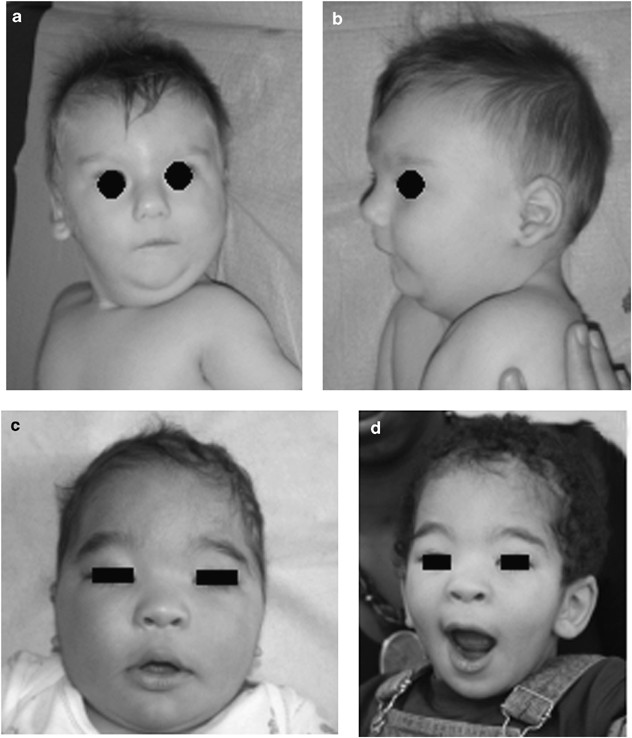 Behoort De lucht meer Titicaca Molecular cytogenetic characterization of terminal 14q32 deletions in two  children with an abnormal phenotype and corpus callosum hypoplasia |  European Journal of Human Genetics
