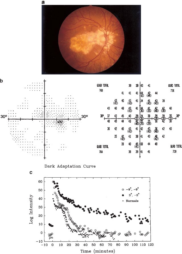 Symptomatic Abnormalities Of Dark Adaptation In Patients - 