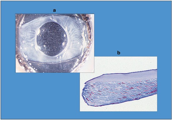 Post Cataract Intraocular Lens Iol Surgery Opacification Eye