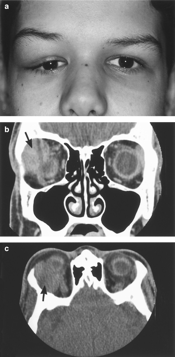 pleomorphic adenoma lacrimal gland ct