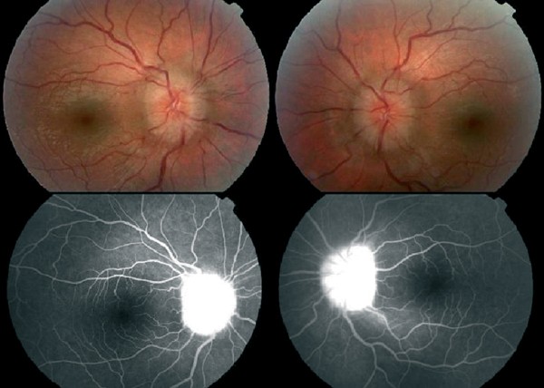 Tubulo-interstitial nephritis and uveitis with bilateral optic disc oedema  | Eye
