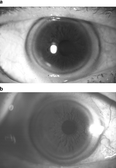 Double arcus cornealis | Eye