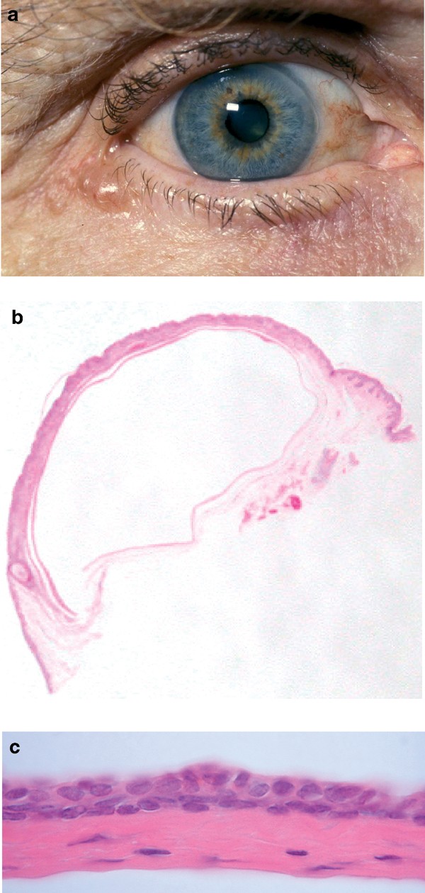 Eccrine hidrocystoma of the eyelid | Eye