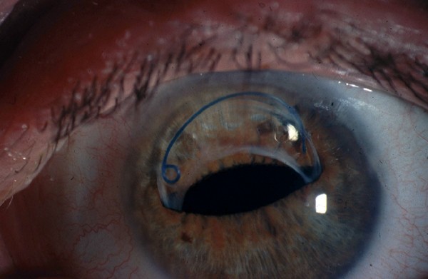Late spontaneous anterior dislocation of an intraocular lens (IOL) with the  capsular bag | Eye