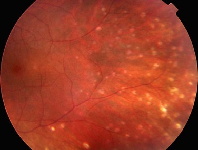 Neovascular glaucoma and sarcoidosis | Eye