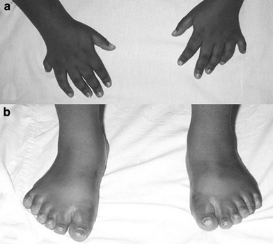 Bardet Biedl Syndrome Associated With Glaucoma Eye