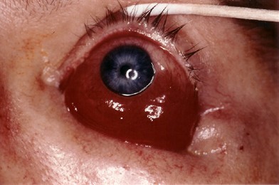 Orbital Floor Fracture An Unusual Late Complication Eye