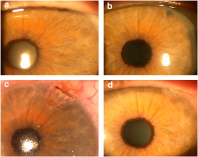 Therapeutic corneal tattoo following peripheral iridotomy complication | Eye