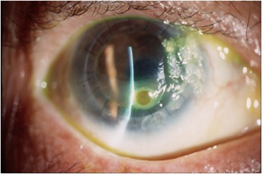 fungal corneal ulcer satellite lesion
